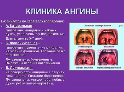 Вирусные инфекции гортани: причины и симптомы