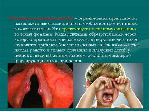 Влияние сухого воздуха и перегрузки на работу голосовых связок