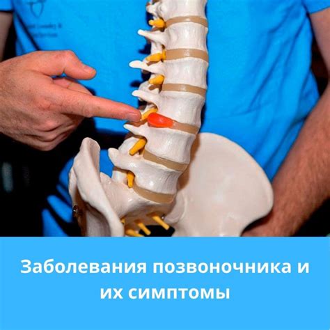 Влияние твердости поверхности на состояние спинного столба при наличии грыжи