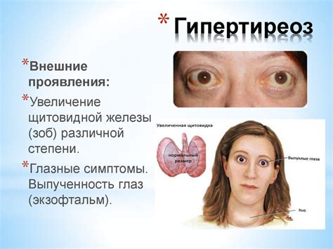 Гипертиреоз: избыток гормонов и сокращение массы тела