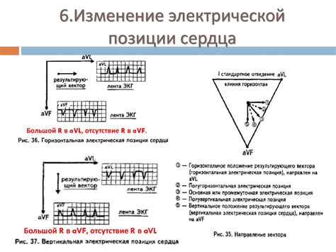 Диагностика неопределенной электрической позиции сердца