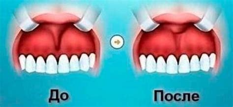 Зачем нужна верхняя уздечка