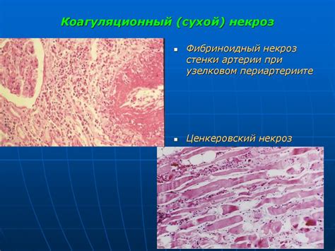 Ишемический некроз: происхождение и механизм развития