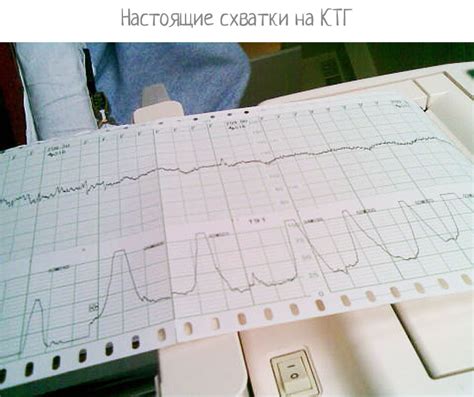 Когда схватки на 37 неделе рассматриваются как естественный процесс
