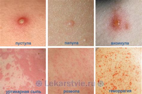 Лабораторные исследования при вариантах сыпи на коже