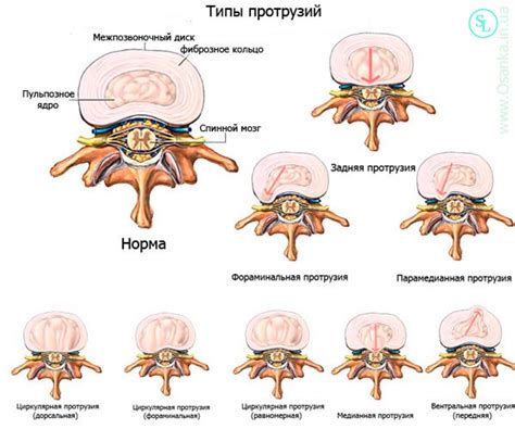 Медианная грыжа: основные характеристики и проблематика