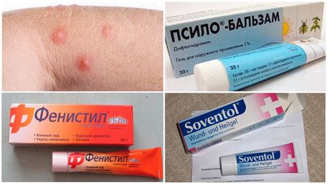 Медицинские препараты для облегчения симптомов воспаления и зуда после укусов насекомых
