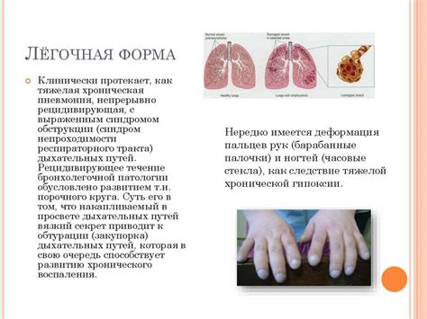 Муковисцидоз: описание и симптомы болезни