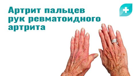 Нарушения в кровообращении: одна из основных причин покалывания пальцев на руках