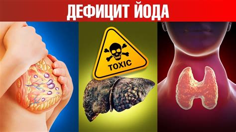 Недостаток йода: причины, симптомы и последствия