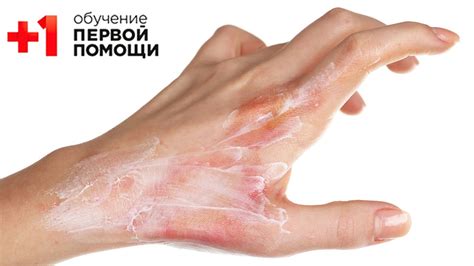 Не использовать лекарственные средства на ожог: 