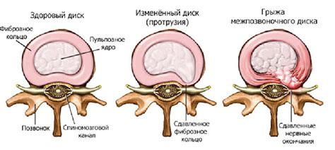 Определение грыжи позвоночника и ее основные виды
