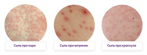 Основные факторы и симптомы красного высыпания на коже ребенка