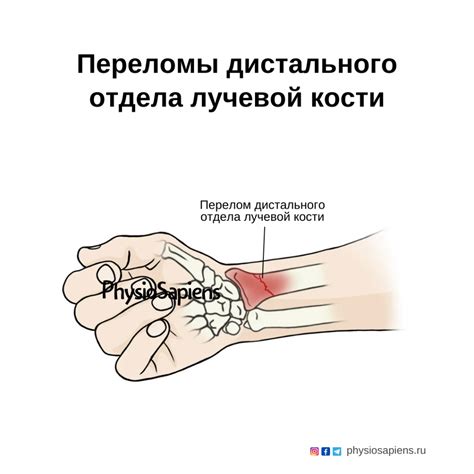 Перелом лучевой кости