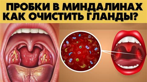 Последствия игнорирования присутствия задавки в горле при непереносимости пищевых продуктов