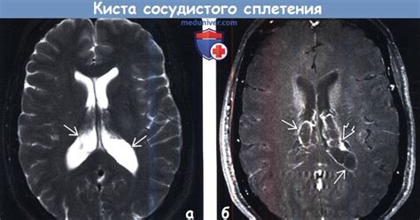 Последствия неоднородности сосудистых сплетений
