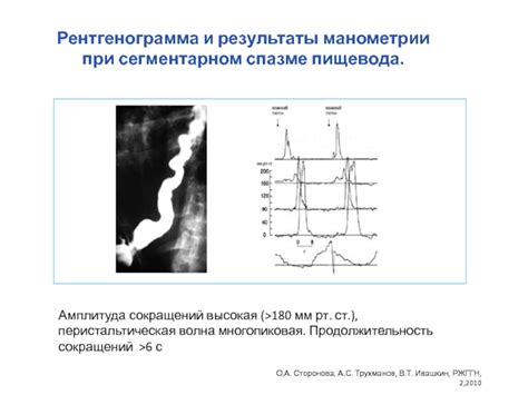 Преимущества и ограничения использования манометрии пищевода