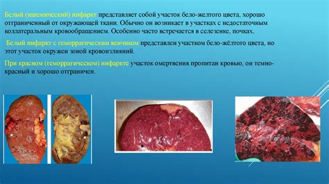 Признаки некроза легкого