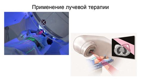 Принцип действия неоадъювантной лучевой терапии