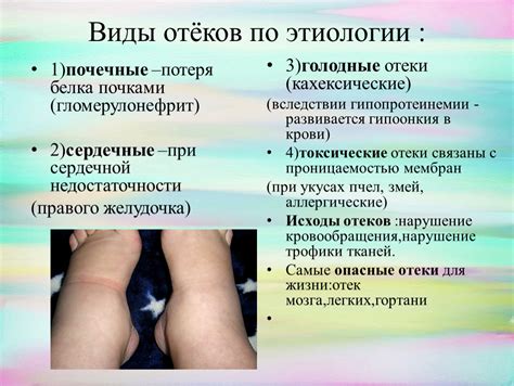 Природа отеков в нижних конечностях и способы укрощения их проявления
