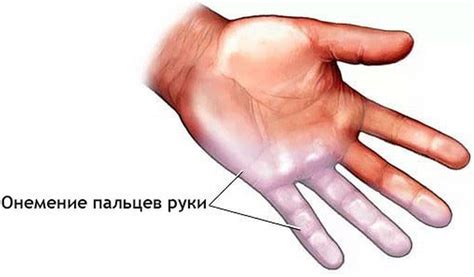 Причины онемения среднего пальца на левой руке