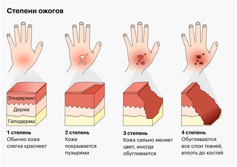 Промывание ожога