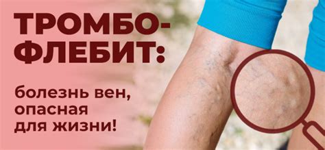 Профилактика неокклюзирующего тромбоза