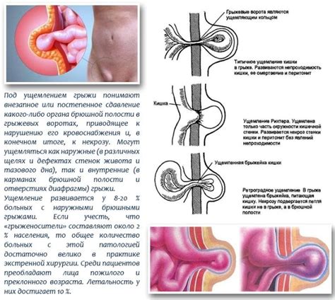 Пупочная грыжа: причины, симптомы и методы лечения