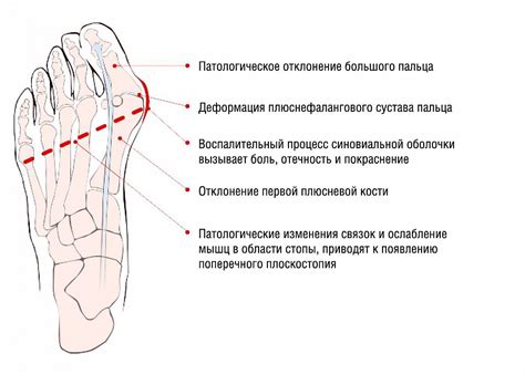 Разнообразные подходы к предотвращению появления патологического состояния на коже стопы