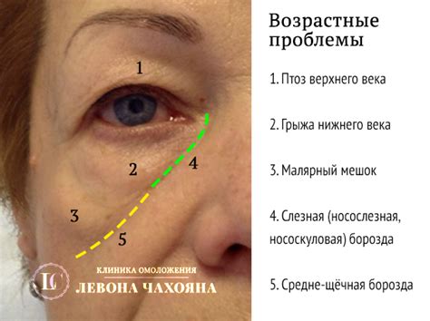 Роль питания в возникновении жирового образования под кожей в области глаз
