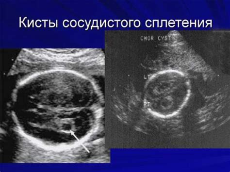 Симптомы неоднородности сосудистых сплетений
