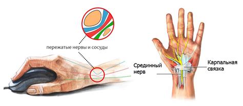 Синдром карпального канала: частая причина онемения пальцев