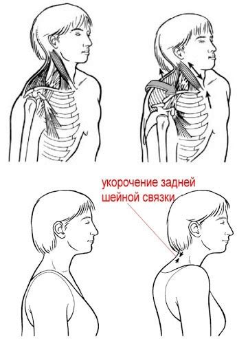 Синдром мышечного перегруза