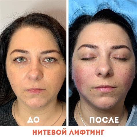 Тайны удачной процедуры "нити коги": ключевые моменты и рекомендации