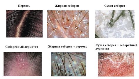 Улучшение состояния кожи головы при проблемах с себореей