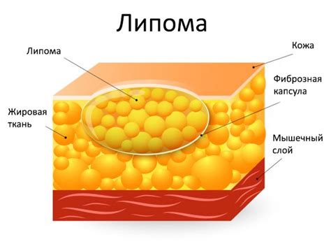 Хирургическое удаление липомы: особенности и последствия операции
