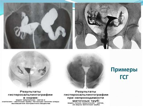 Что такое непроходимость маточных труб