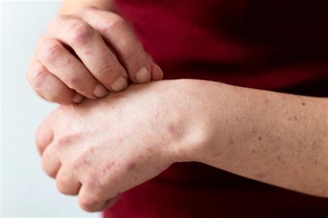  Заболевания, передаваемые инфекцией и проявляющиеся кожной сыпью 
