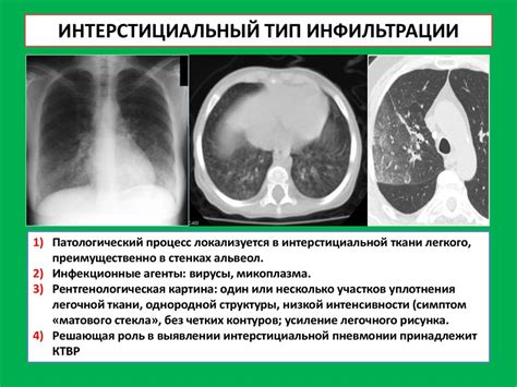  Основы пневмонии: раскрывая природу болезни 