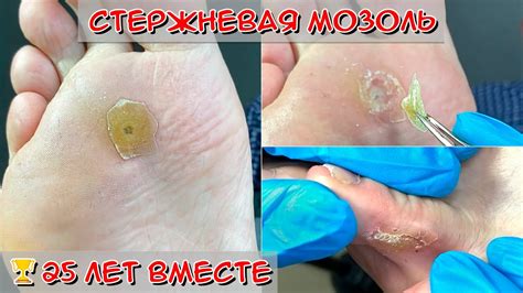  Устранение зуда и избавление от покраснения на стопе: эффективные методы и средства 