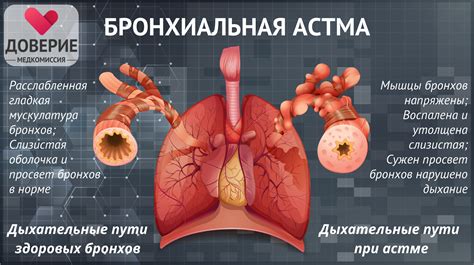 Бронхиальная астма и ГТО: основные аспекты