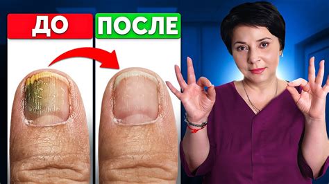 Варианты удаления ногтей навсегда