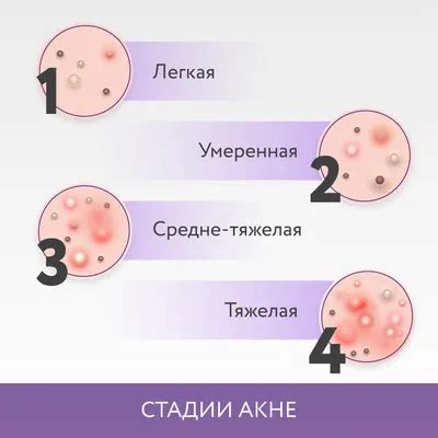 Виды акне в зависимости от места появления