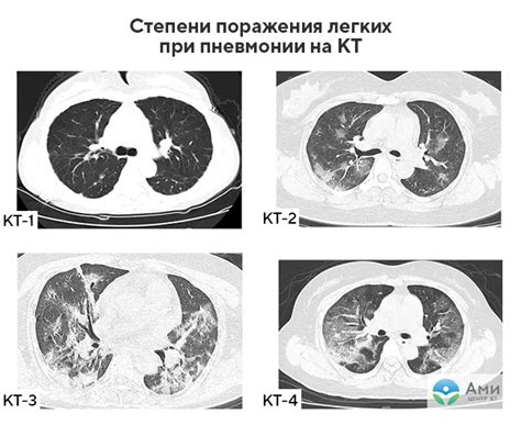 Влияние КТ легких на результаты и возможность проведения исследования при температуре