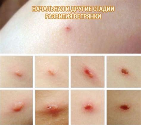 Влияние возраста на длительность проявления симптомов ветрянки