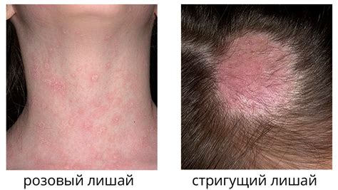 Влияние загара на развитие лишая