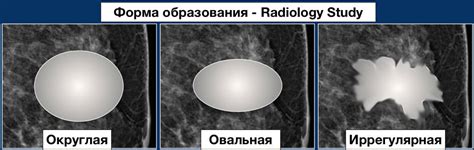 Влияние минусов рентгенологии на результат маммографии