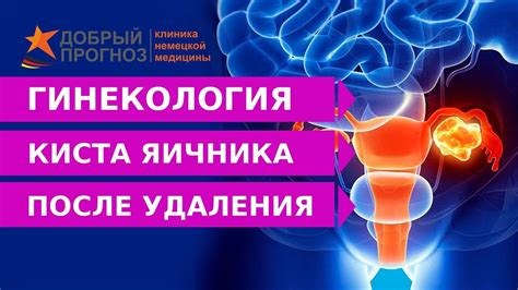 Восстановление после мини-инвазивного удаления кисты яичника