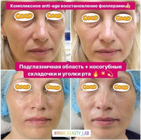Восстановление после процедуры филлерами
