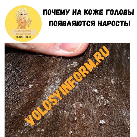 Вред коже головы